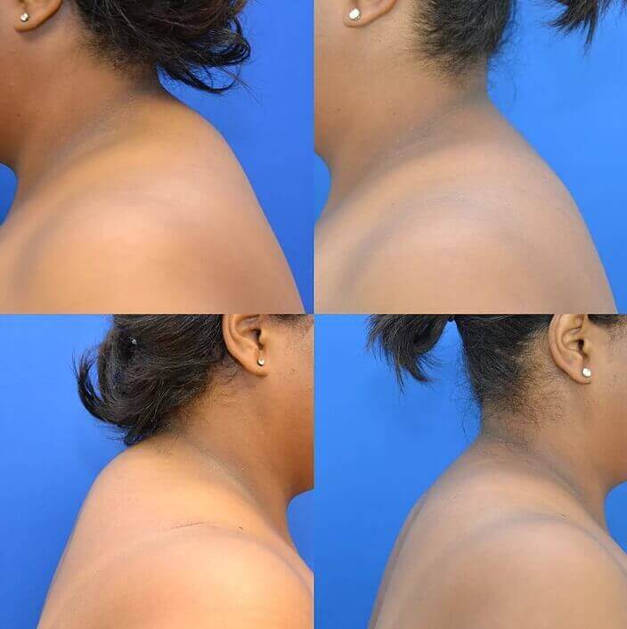 Buffalo Hump Removal In Dubai Abu Dhabi And Al Ain